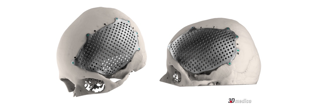 Thumb Custom Made Neurochirurgia